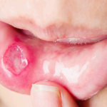 구내염 빨리 낫는법과 치료, 증상과 원인까지 4가지 완벽 정리