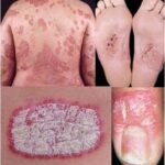 2030 피부 건선, 약물 보단 꾸준한 보습!